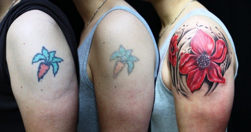 Tattoo removal, Remove Tattoo, Tattoo