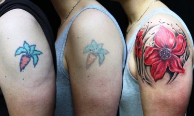 Tattoo removal, Remove Tattoo, Tattoo