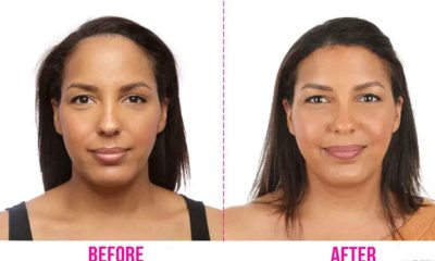 Forehead Reduction (hairline lowering) Surgery