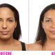 Forehead Reduction (hairline lowering) Surgery