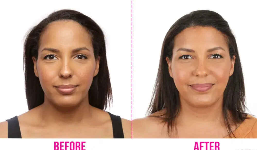 Forehead Reduction (hairline lowering) Surgery