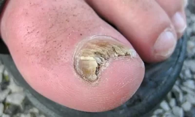 nail fungus