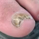 nail fungus