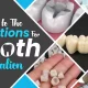 Tooth restorations