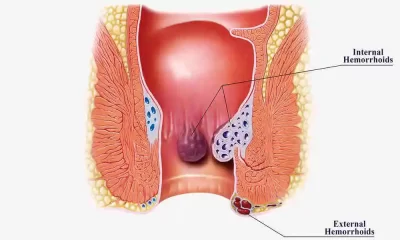hemorrhoids last