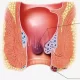 hemorrhoids last