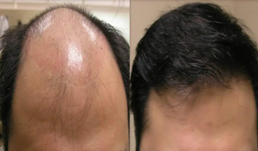 Hair Loss treatment