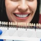 Composite Veneers