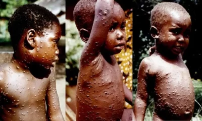 Monkeypox Virus Symptoms, Causes, Treatment, Prevention & More