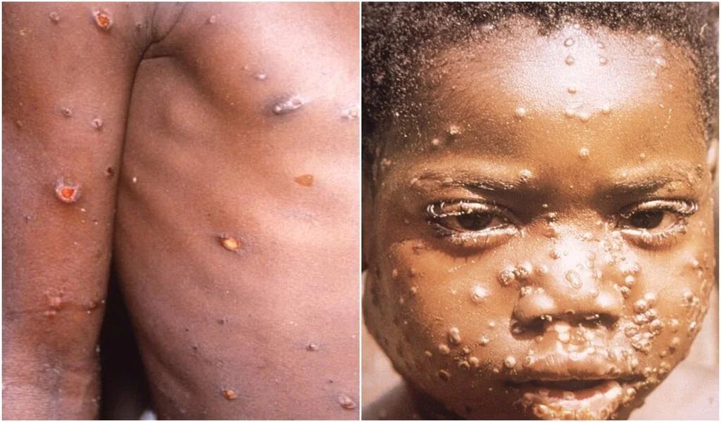 Monkeypox Which Countries Have Reported The First Monkeypox Cases