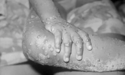 UK Stocking Up On Vaccines As Monkeypox Cases Rise To 20
