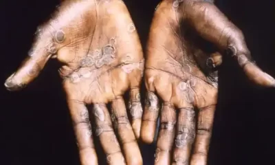 WHO Expects An Increase In Monkeypox Cases The Globally