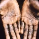 Monkeypox Cases In UK Crosses 1000-Mark, Europe Accounts For 86% Of Infections Worldwide