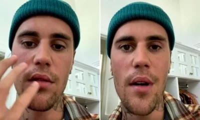 What is Ramsay Hunt Syndrome & Its Symptoms The Virus Attacked On Justin Bieber's Face