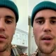 What is Ramsay Hunt Syndrome & Its Symptoms The Virus Attacked On Justin Bieber's Face