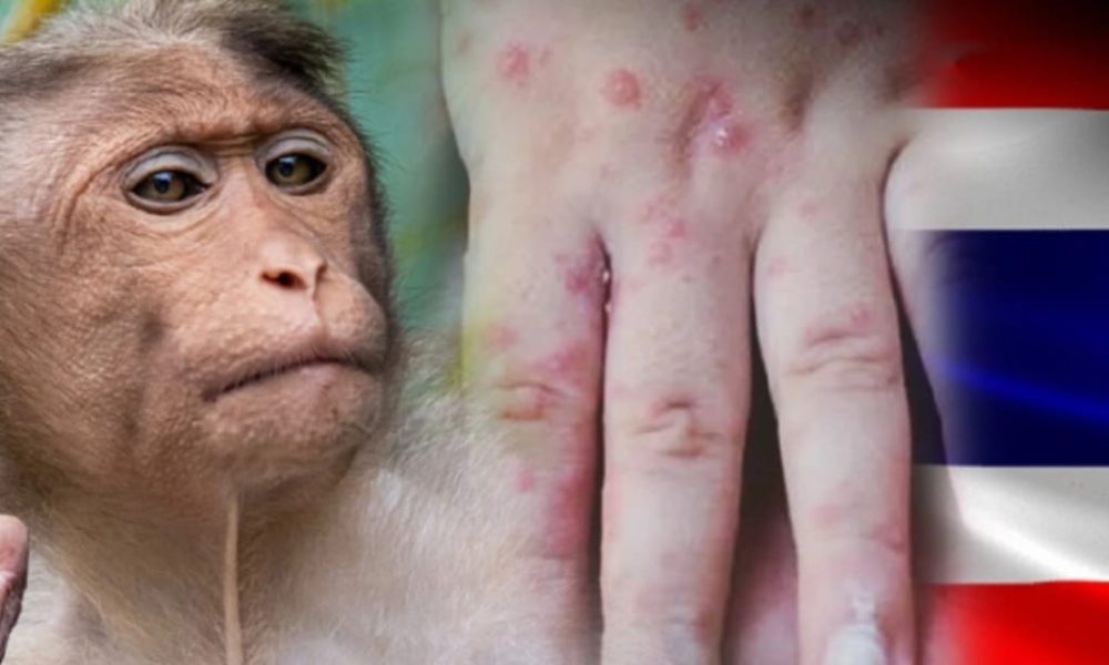 Public in Thailand Urged to Stay Calm Over Monkeypox