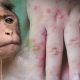 Public in Thailand Urged to Stay Calm Over Monkeypox