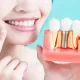 How To Protect Dental Implants So They Last Forever