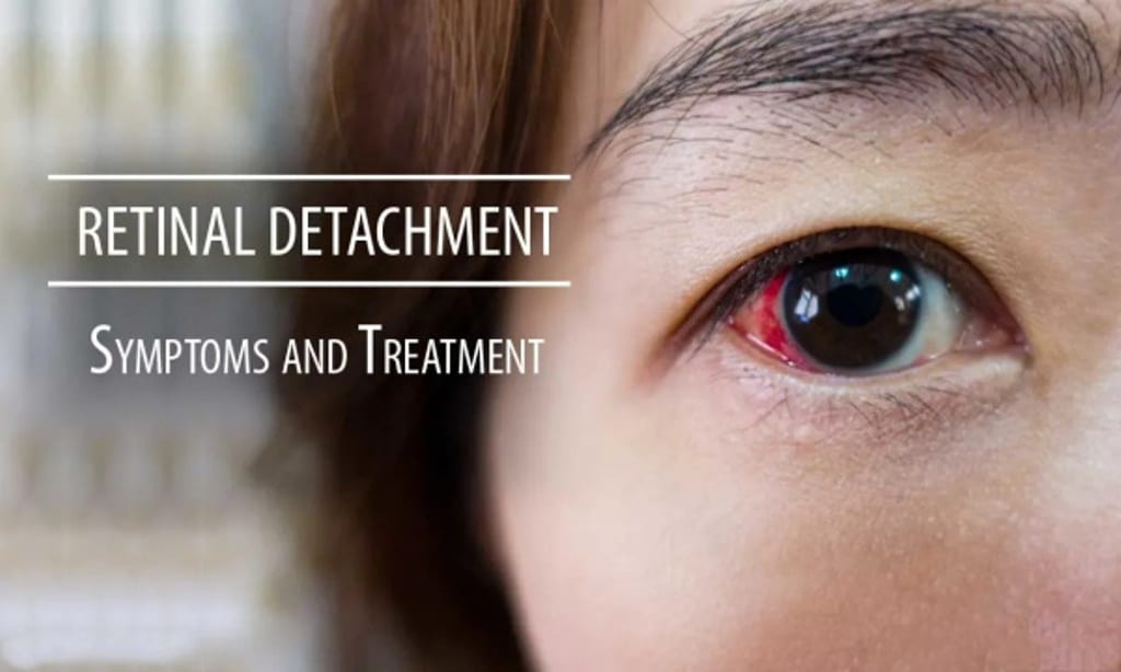 Retinal Detachment