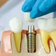 Dental Implant Procedure: What you Should Expect
