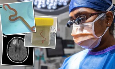 Australian Surgeon Finds 3 Inch Live Worm in Woman's Brain