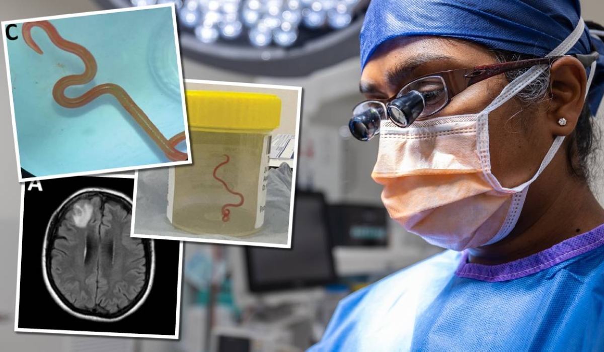 Australian Surgeon Finds 3 Inch Live Worm in Woman's Brain