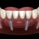 All on 4 Dental Implants - A Permanent Solution for Tooth Loss