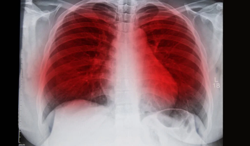 Lung Cancer Prediction Tool Versus Protein-Based Model