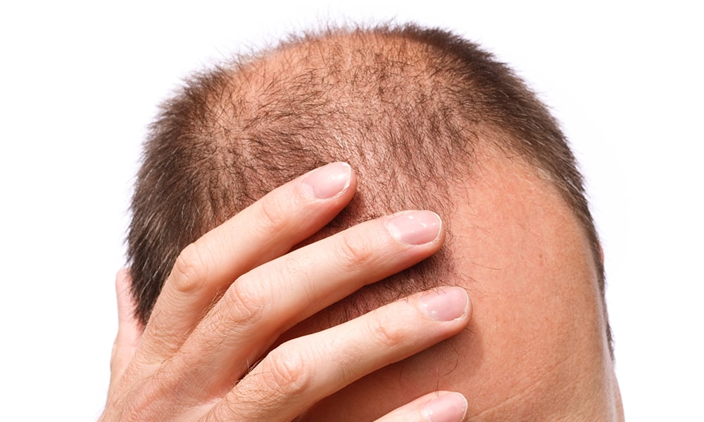 Hair Transplant