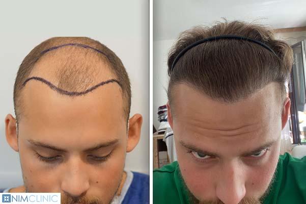 Hair Transplant