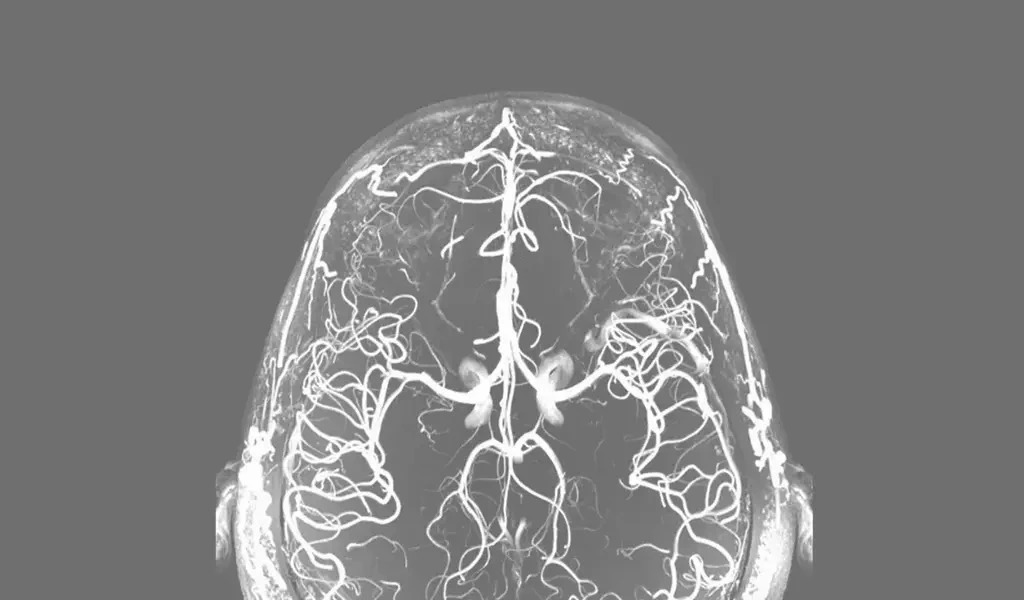 "Risk of Early-Onset Dementia is Increased By Alcohol Misuse And Loneliness."