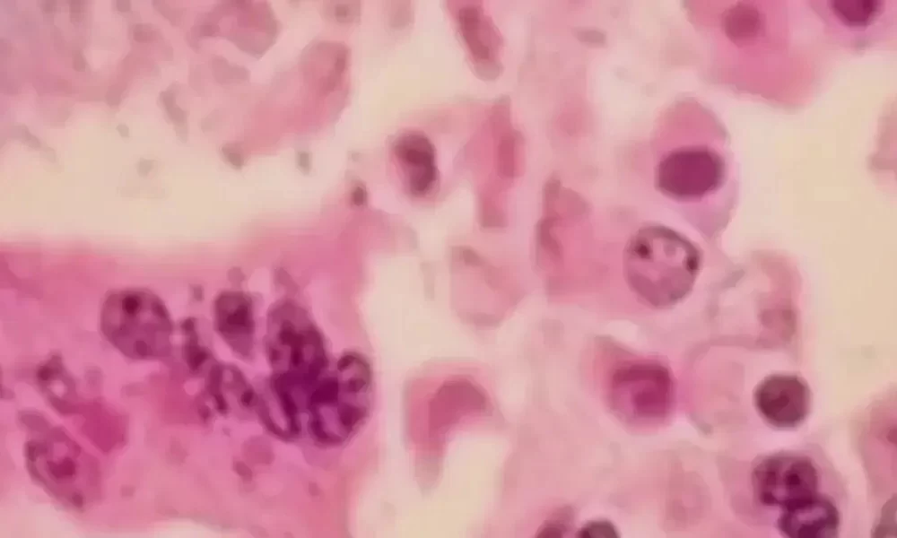 Measles confirmed in metro Atlanta for the first time since 2020