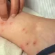 Bed Bug Bites Treatment Learn how to get rid of itchy bed bug bites fast