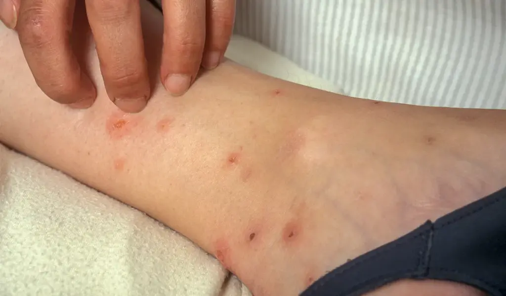 Bed Bug Bites Treatment Learn how to get rid of itchy bed bug bites fast