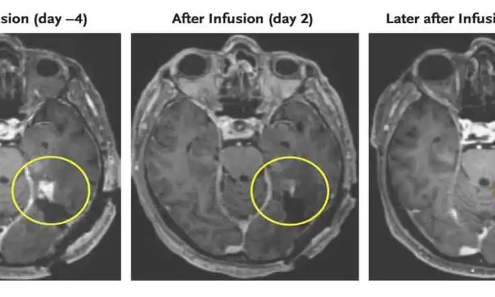 Brain Cancer Tumours Shrank in Early Tests With a New Strategy