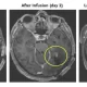 Brain Cancer Tumours Shrank in Early Tests With a New Strategy