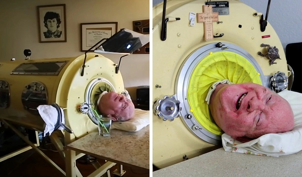 Paul Alexander, a polio Survivor who lived inside an Iron Lung for 72 Years, has Died