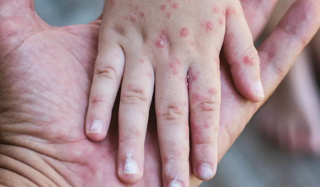 What to Know about Measles Outbreaks in the US Understanding the Impact and Urgency of Vaccination