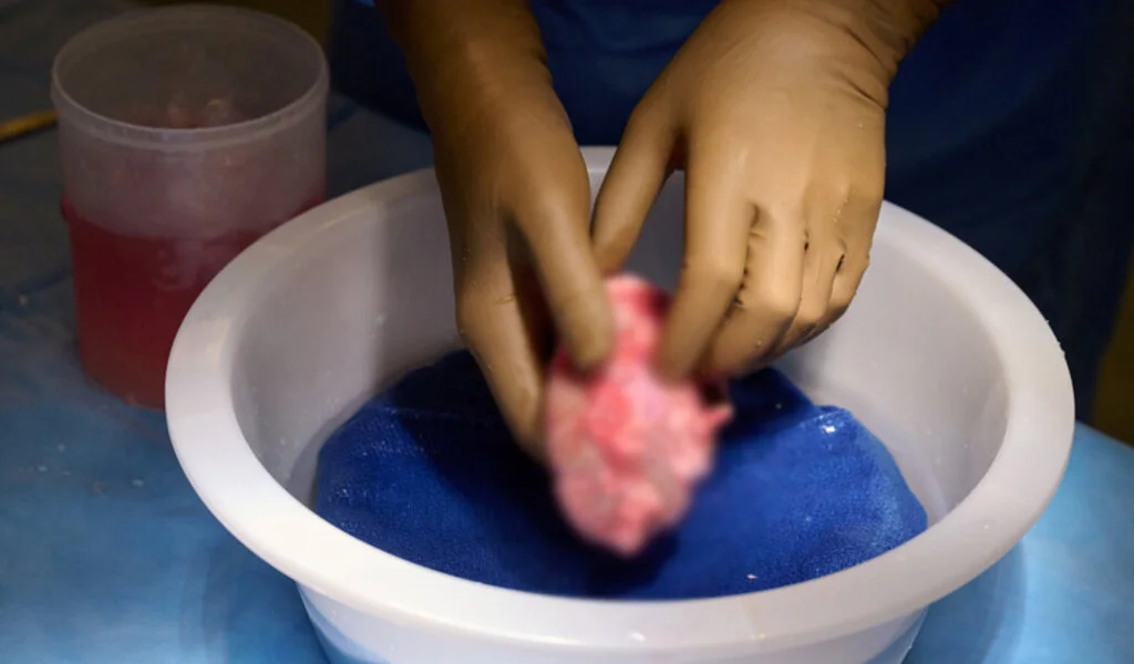 Pig Kidney Transplant Successful For First Living Human