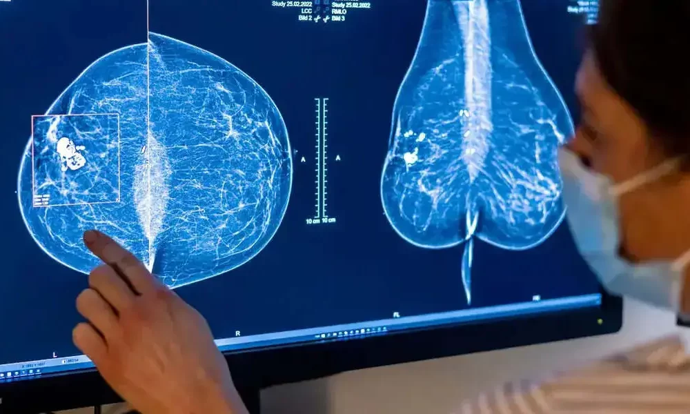 Breast Cancer Treatment Is Delayed By One-Third Of Young Women