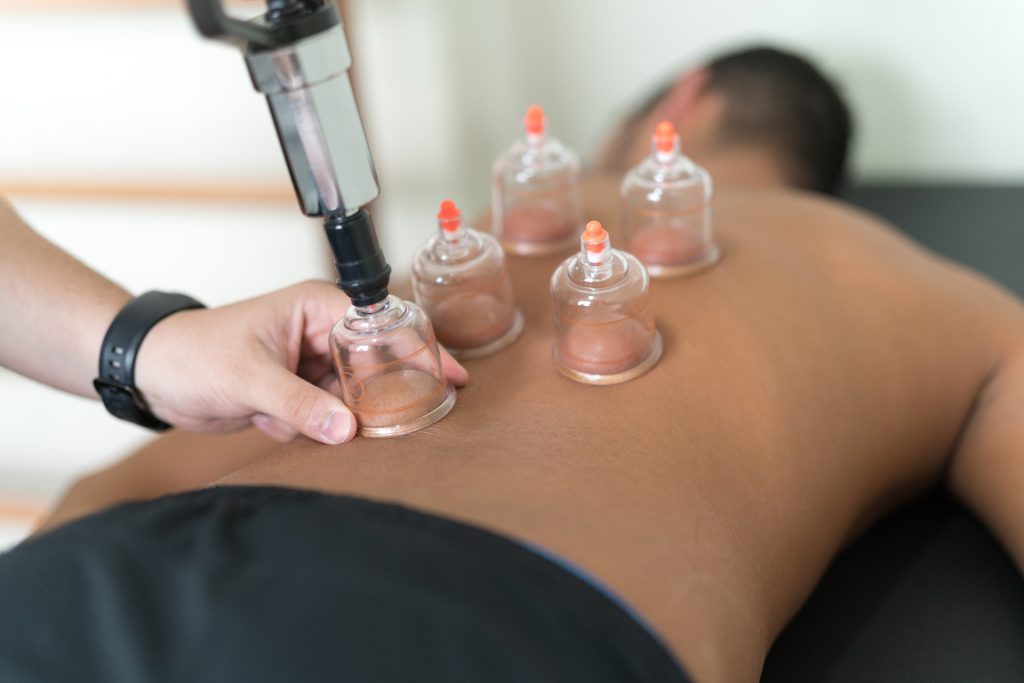 Dry Needling And Cupping Therapy