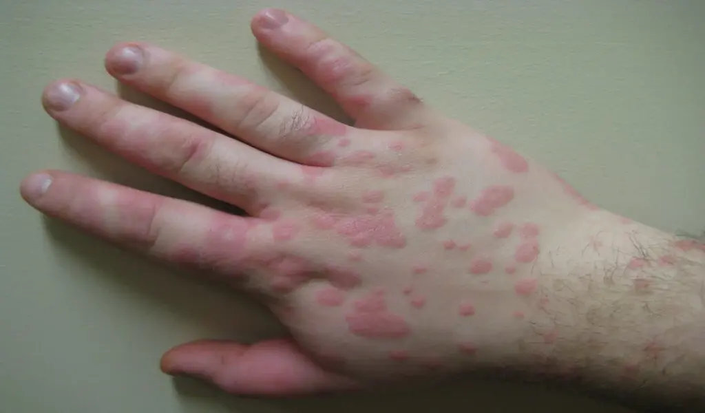 Erythema Multiforme: Demystifying the Bullseye Rash