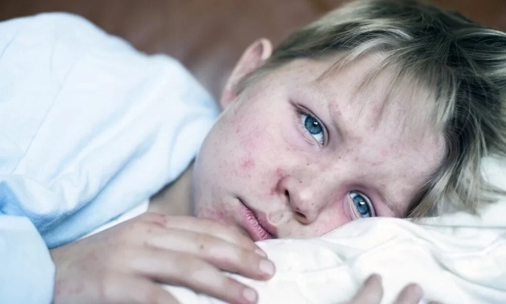 Measles Cases Rise Across Europe, WHO and UNICEF issue Warning