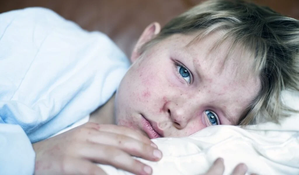 Measles Cases Rise Across Europe, WHO and UNICEF issue Warning