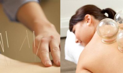 Dry Needling And Cupping Therapy