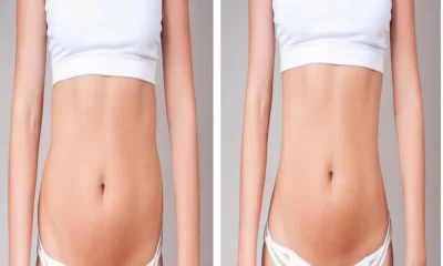 Can a Tummy Tuck Remove All Belly Fat?