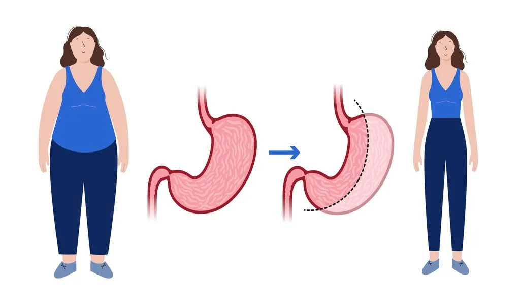 Whats Factors Influencing Gastric Sleeve Costs in Turkey